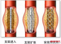 <b>心脏支架术后患者寿命到底有多长？</b>