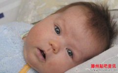 荨麻疹的治疗方法有哪些？