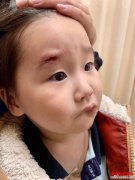 <b>赵文卓女儿脸部受伤缝七针 小姑娘真的是很勇敢</b>